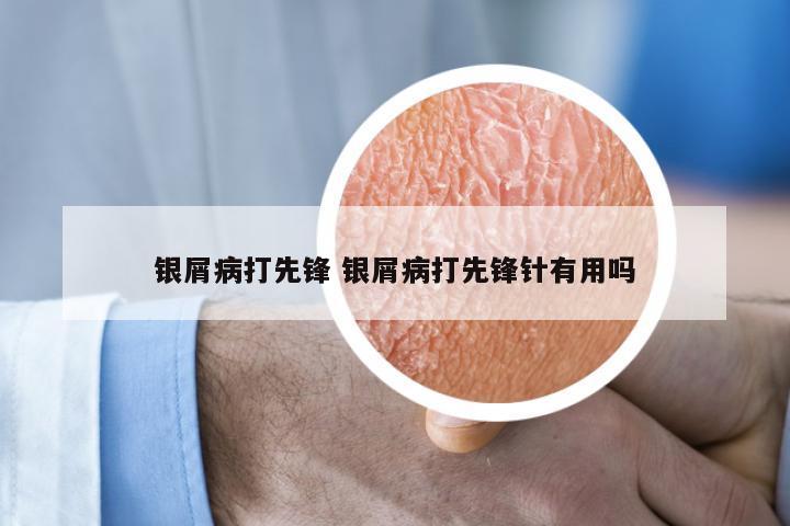 银屑病打先锋 银屑病打先锋针有用吗