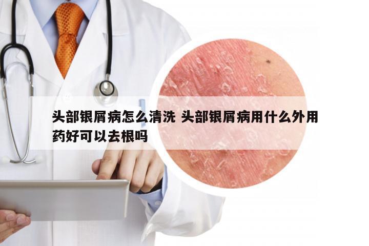 头部银屑病怎么清洗 头部银屑病用什么外用药好可以去根吗