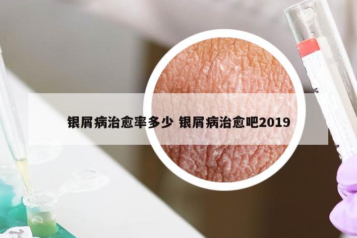 银屑病治愈率多少 银屑病治愈吧2019