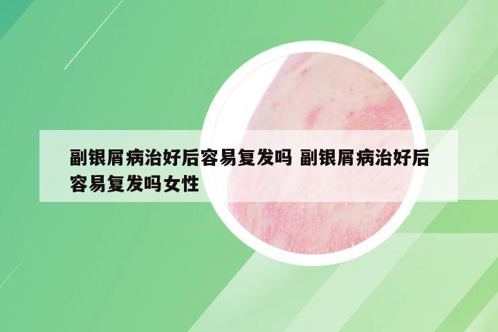 副银屑病治好后容易复发吗 副银屑病治好后容易复发吗女性