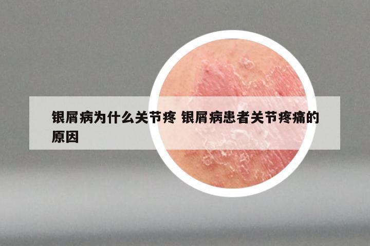 银屑病为什么关节疼 银屑病患者关节疼痛的原因