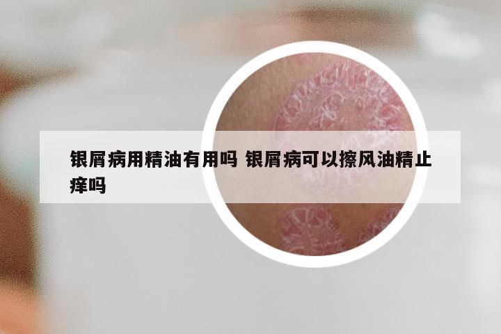 银屑病用精油有用吗 银屑病可以擦风油精止痒吗