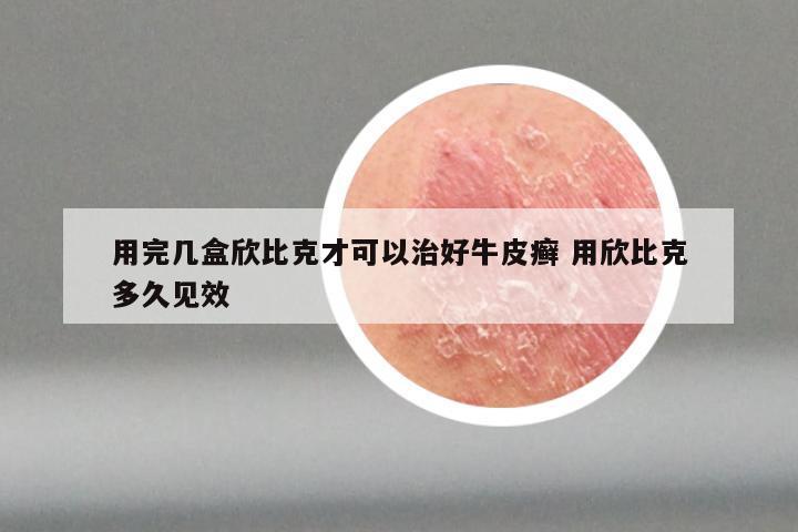 用完几盒欣比克才可以治好牛皮癣 用欣比克多久见效