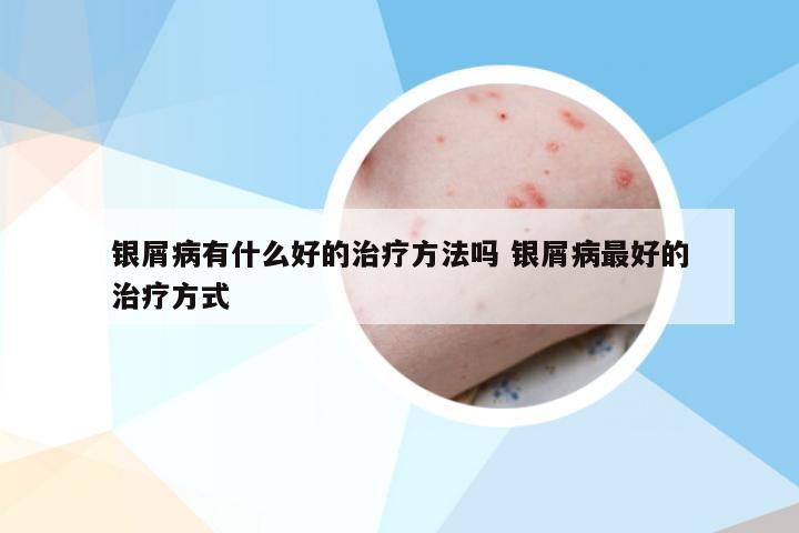 银屑病有什么好的治疗方法吗 银屑病最好的治疗方式