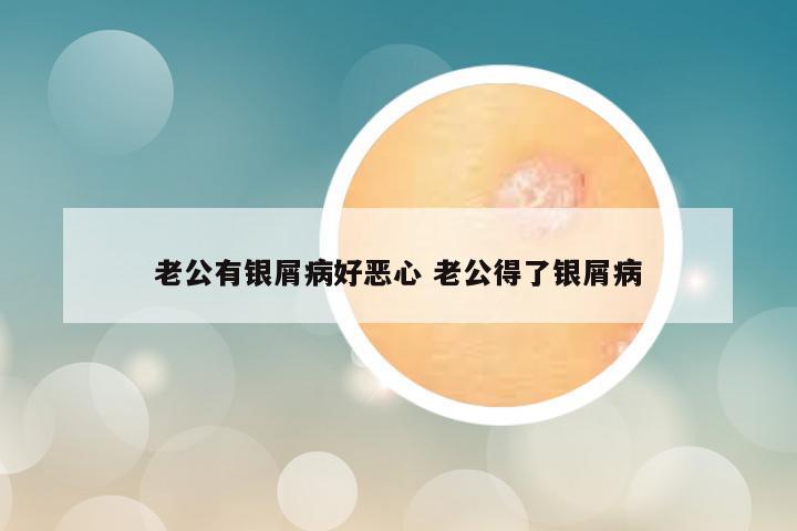 老公有银屑病好恶心 老公得了银屑病