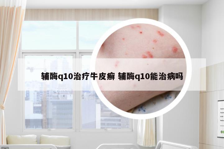 辅酶q10治疗牛皮癣 辅酶q10能治病吗