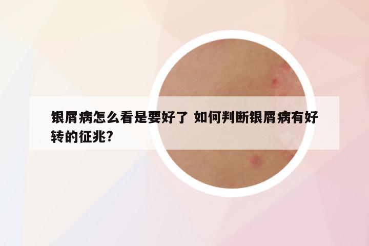 银屑病怎么看是要好了 如何判断银屑病有好转的征兆?