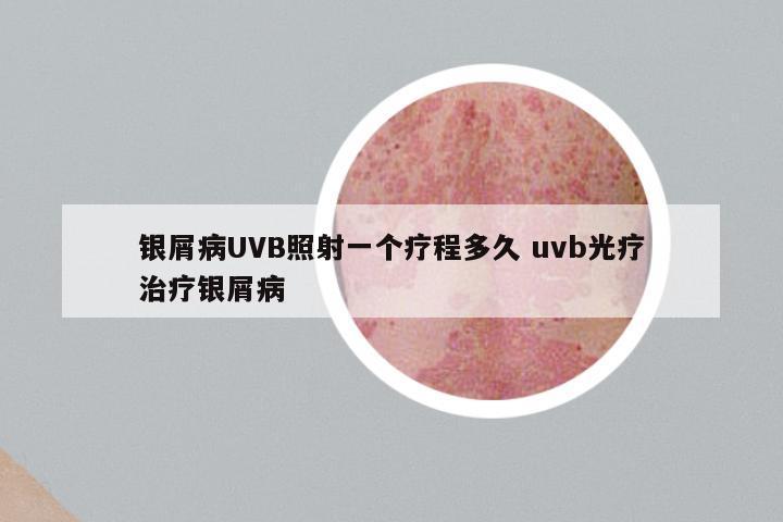 银屑病UVB照射一个疗程多久 uvb光疗治疗银屑病