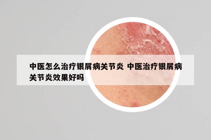 中医怎么治疗银屑病关节炎 中医治疗银屑病关节炎效果好吗