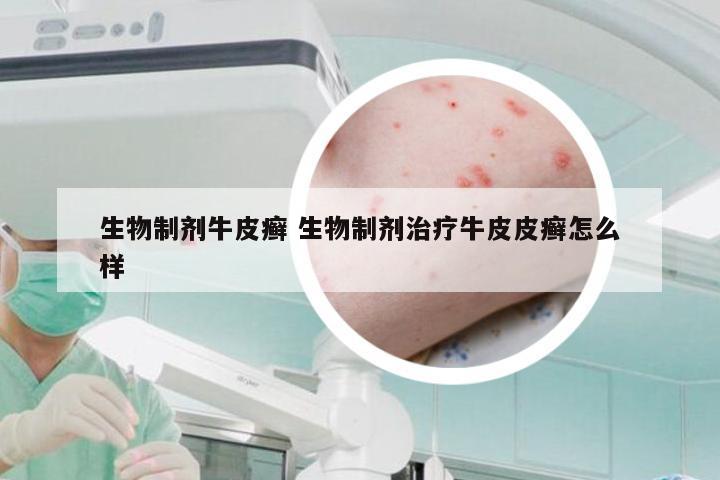 生物制剂牛皮癣 生物制剂治疗牛皮皮癣怎么样