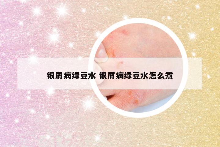 银屑病绿豆水 银屑病绿豆水怎么煮