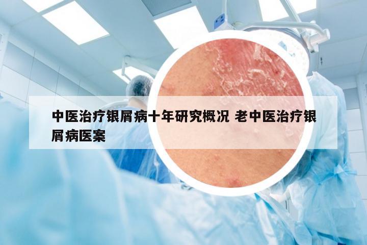 中医治疗银屑病十年研究概况 老中医治疗银屑病医案