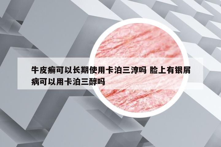 牛皮癣可以长期使用卡泊三淳吗 脸上有银屑病可以用卡泊三醇吗