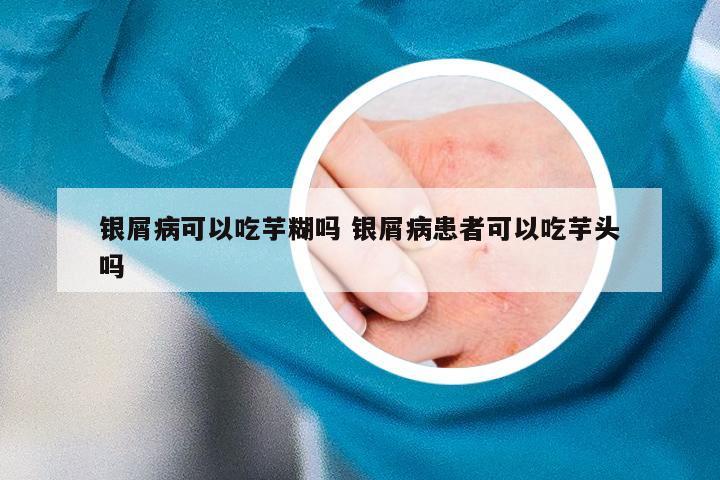 银屑病可以吃芋糊吗 银屑病患者可以吃芋头吗