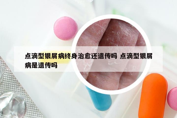 点滴型银屑病终身治愈还遗传吗 点滴型银屑病是遗传吗