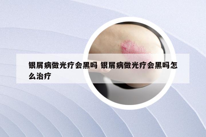 银屑病做光疗会黑吗 银屑病做光疗会黑吗怎么治疗