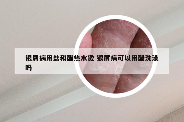 银屑病用盐和醋热水烫 银屑病可以用醋洗澡吗