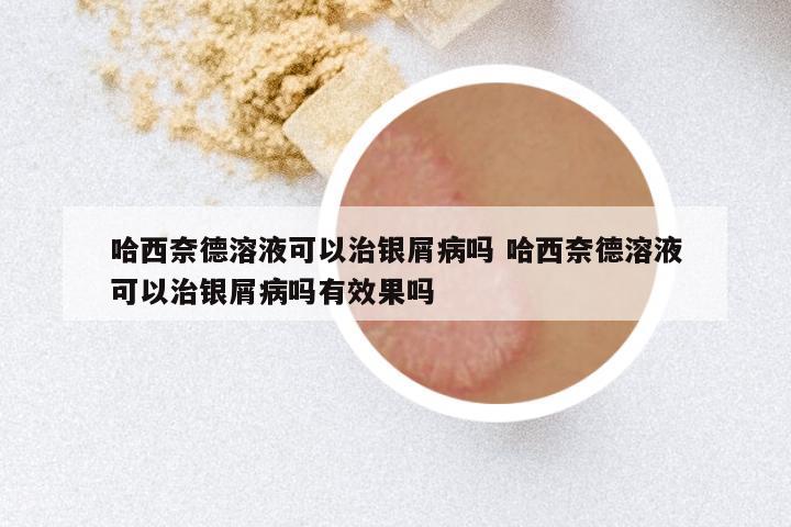 哈西奈德溶液可以治银屑病吗 哈西奈德溶液可以治银屑病吗有效果吗