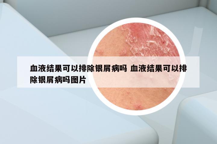 血液结果可以排除银屑病吗 血液结果可以排除银屑病吗图片