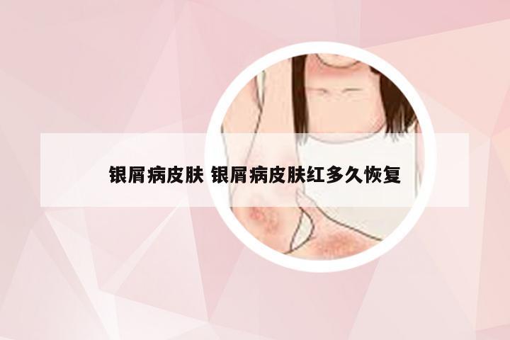 银屑病皮肤 银屑病皮肤红多久恢复