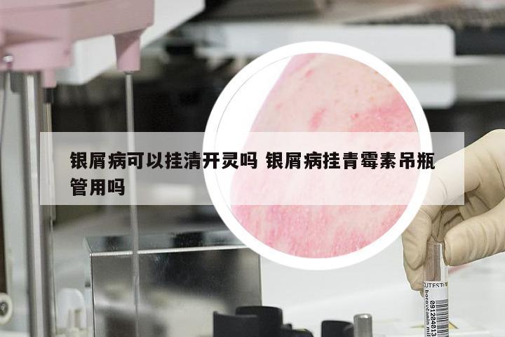 银屑病可以挂清开灵吗 银屑病挂青霉素吊瓶管用吗