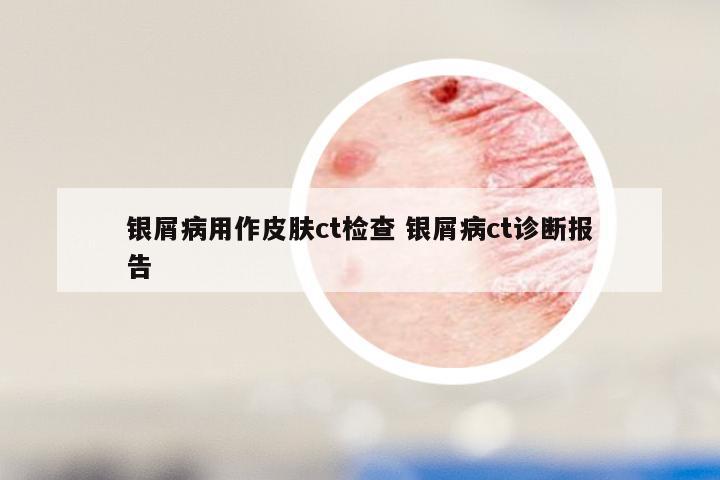 银屑病用作皮肤ct检查 银屑病ct诊断报告