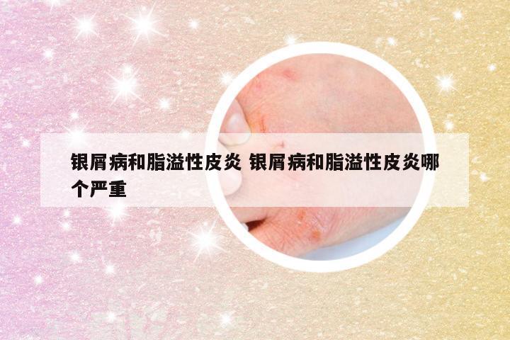 银屑病和脂溢性皮炎 银屑病和脂溢性皮炎哪个严重