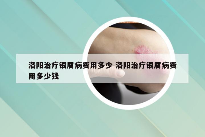 洛阳治疗银屑病费用多少 洛阳治疗银屑病费用多少钱