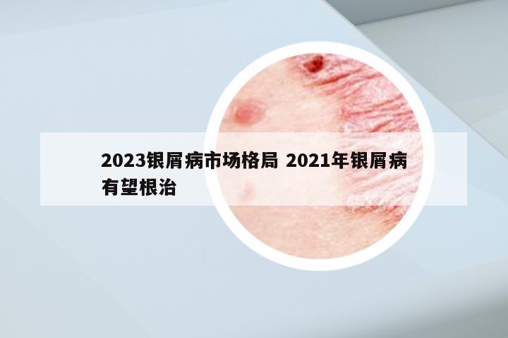 2023银屑病市场格局 2021年银屑病有望根治