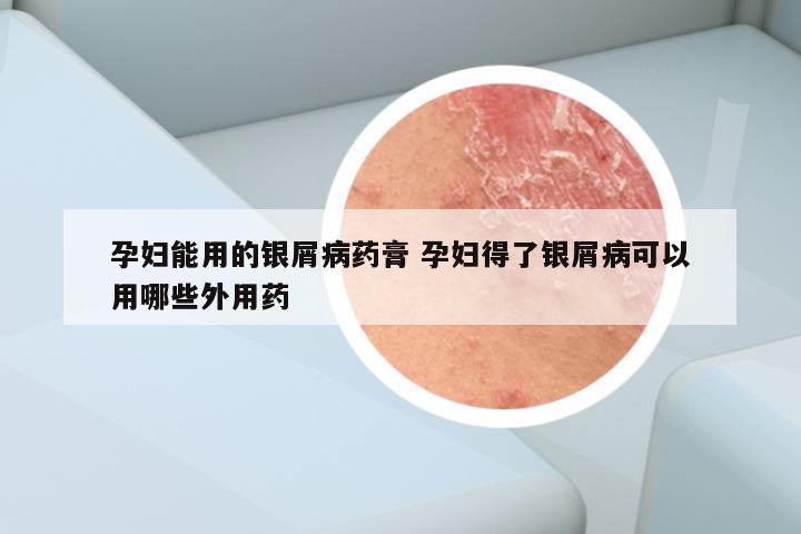 孕妇能用的银屑病药膏 孕妇得了银屑病可以用哪些外用药