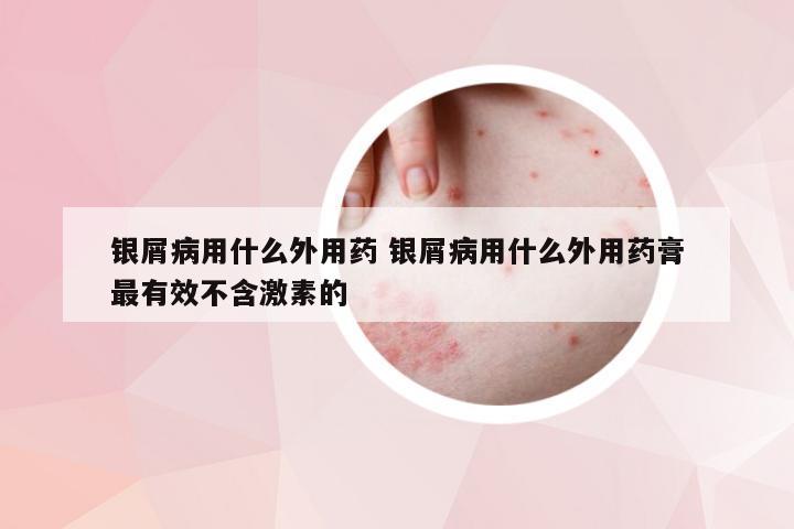 银屑病用什么外用药 银屑病用什么外用药膏最有效不含激素的