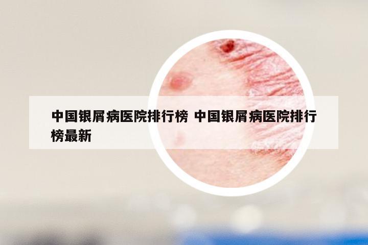 中国银屑病医院排行榜 中国银屑病医院排行榜最新