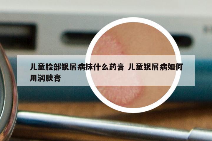 儿童脸部银屑病抹什么药膏 儿童银屑病如何用润肤膏