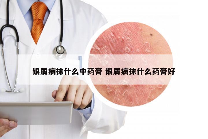 银屑病抹什么中药膏 银屑病抹什么药膏好