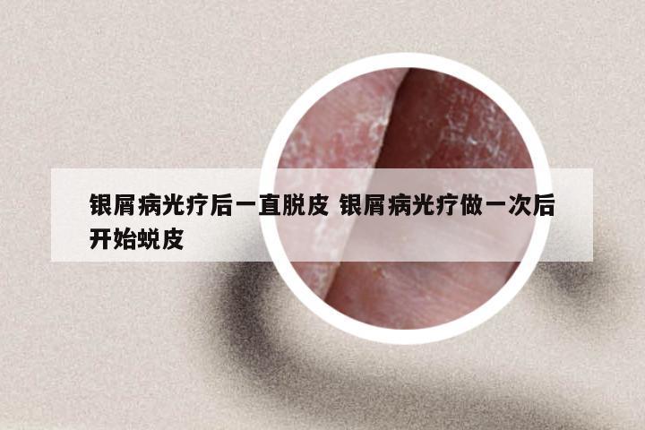 银屑病光疗后一直脱皮 银屑病光疗做一次后开始蜕皮