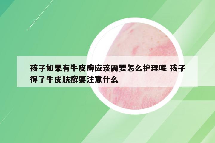 孩子如果有牛皮癣应该需要怎么护理呢 孩子得了牛皮肤癣要注意什么