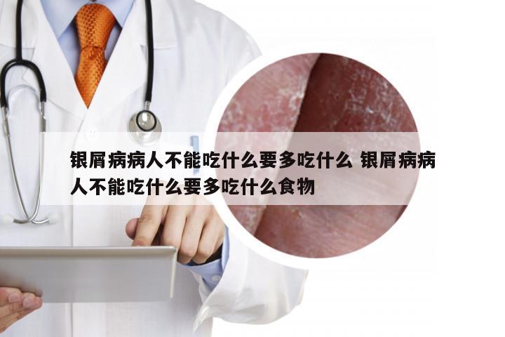 银屑病病人不能吃什么要多吃什么 银屑病病人不能吃什么要多吃什么食物