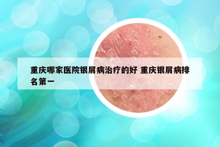 重庆哪家医院银屑病治疗的好 重庆银屑病排名第一