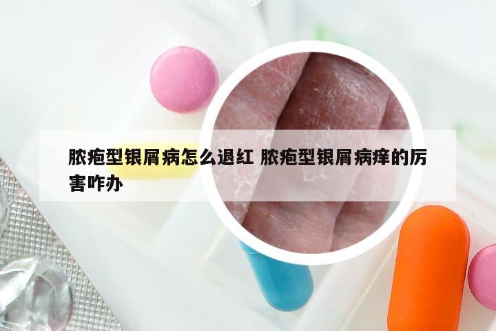 脓疱型银屑病怎么退红 脓疱型银屑病痒的厉害咋办