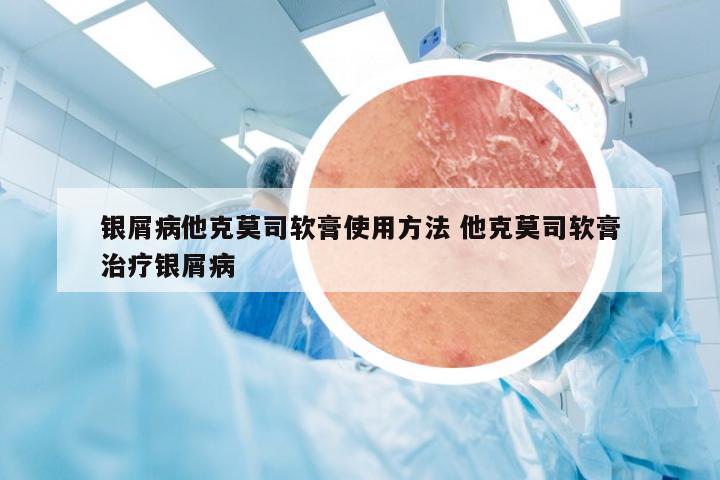 银屑病他克莫司软膏使用方法 他克莫司软膏治疗银屑病