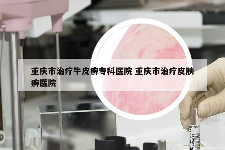 重庆市治疗牛皮癣专科医院 重庆市治疗皮肤癣医院