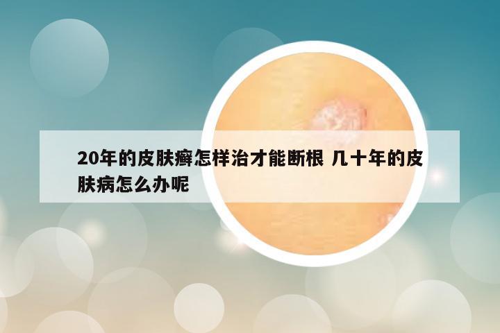 20年的皮肤癣怎样治才能断根 几十年的皮肤病怎么办呢