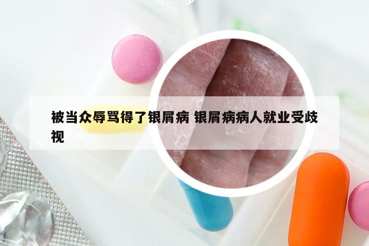 被当众辱骂得了银屑病 银屑病病人就业受歧视