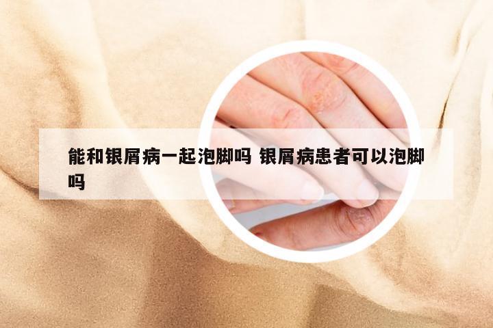 能和银屑病一起泡脚吗 银屑病患者可以泡脚吗