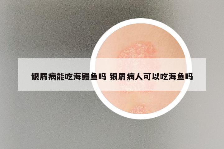 银屑病能吃海鳗鱼吗 银屑病人可以吃海鱼吗