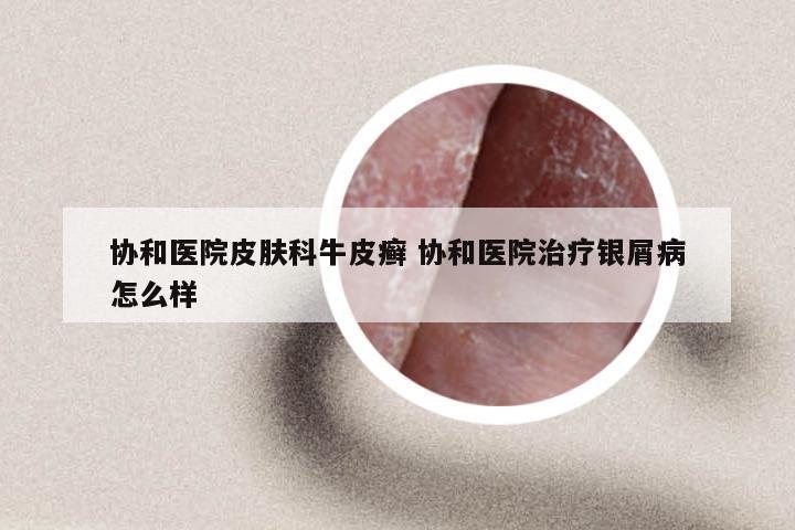 协和医院皮肤科牛皮癣 协和医院治疗银屑病怎么样