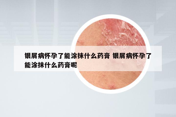 银屑病怀孕了能涂抹什么药膏 银屑病怀孕了能涂抹什么药膏呢