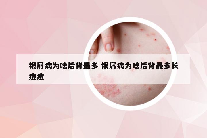 银屑病为啥后背最多 银屑病为啥后背最多长痘痘