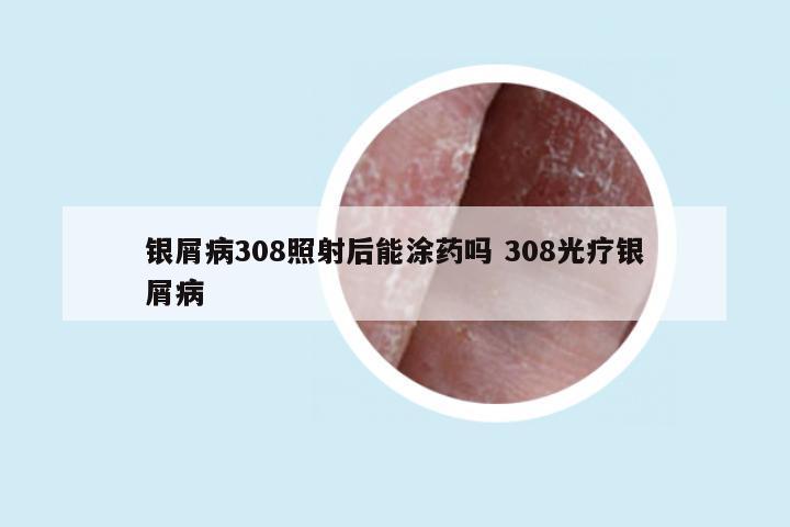 银屑病308照射后能涂药吗 308光疗银屑病