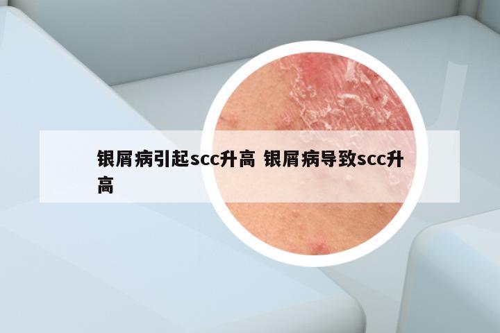 银屑病引起scc升高 银屑病导致scc升高